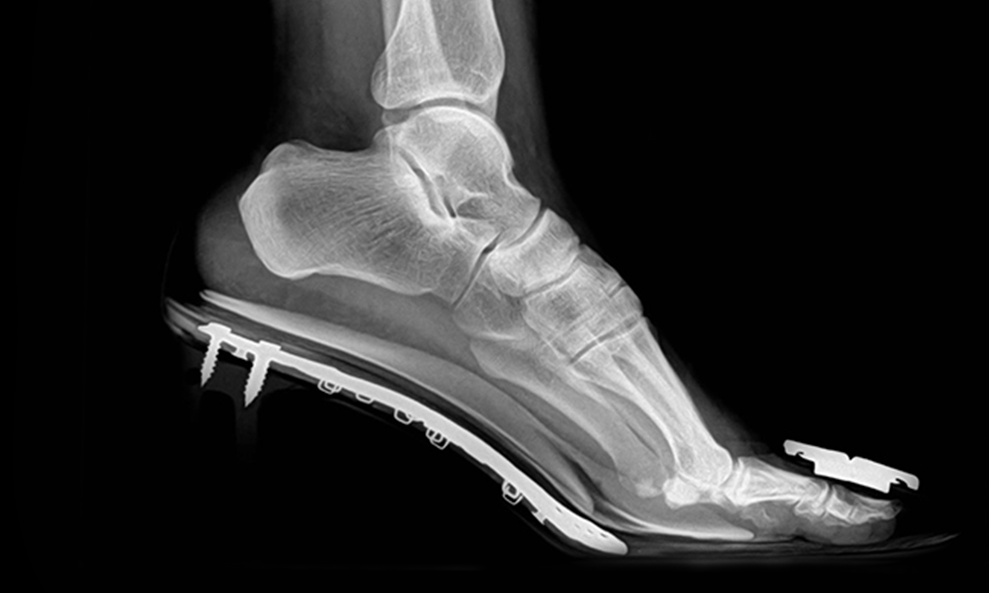 X-ray of a Foot on E'MAR Heels