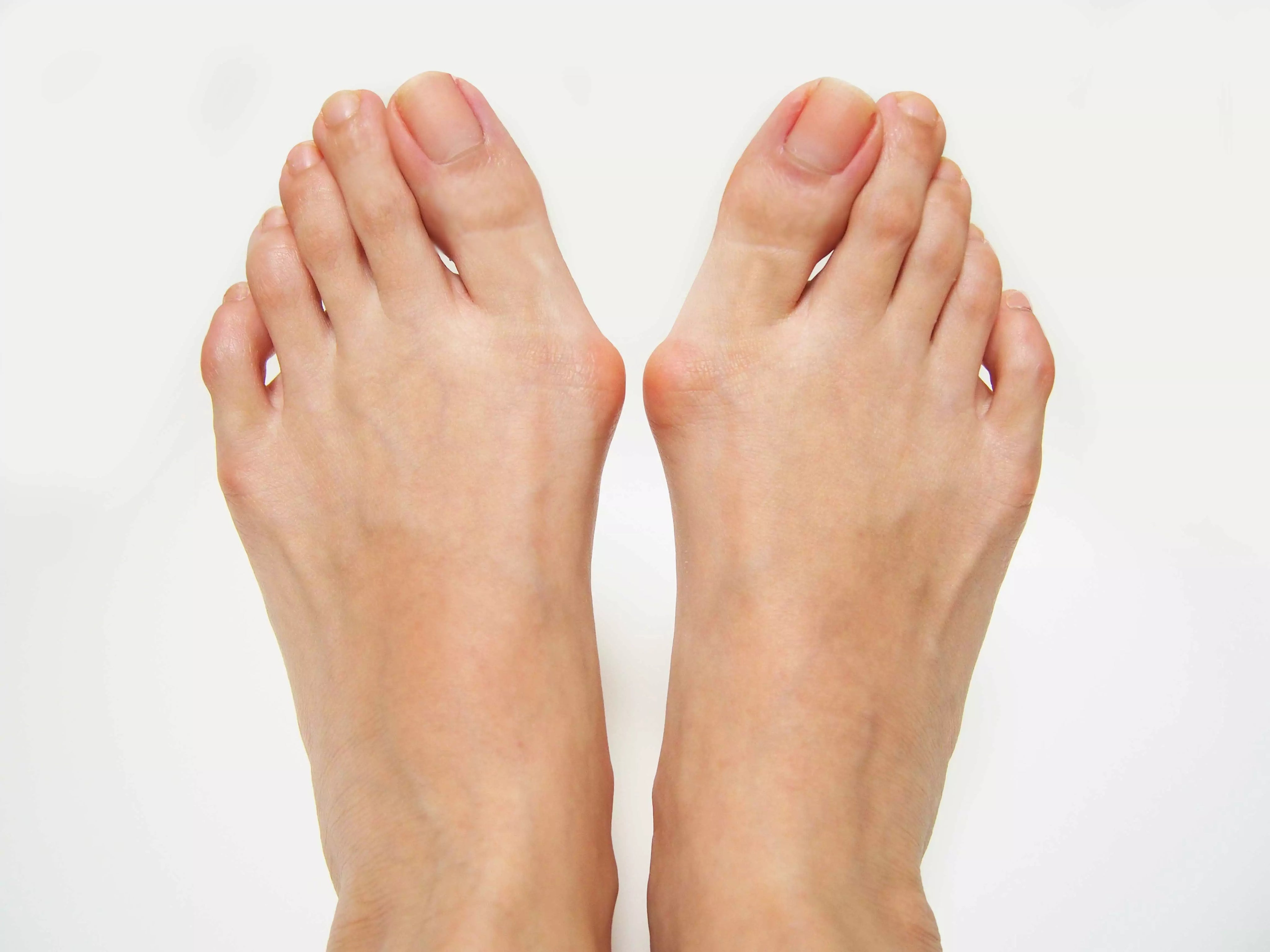 Bunions Causes And Symptoms