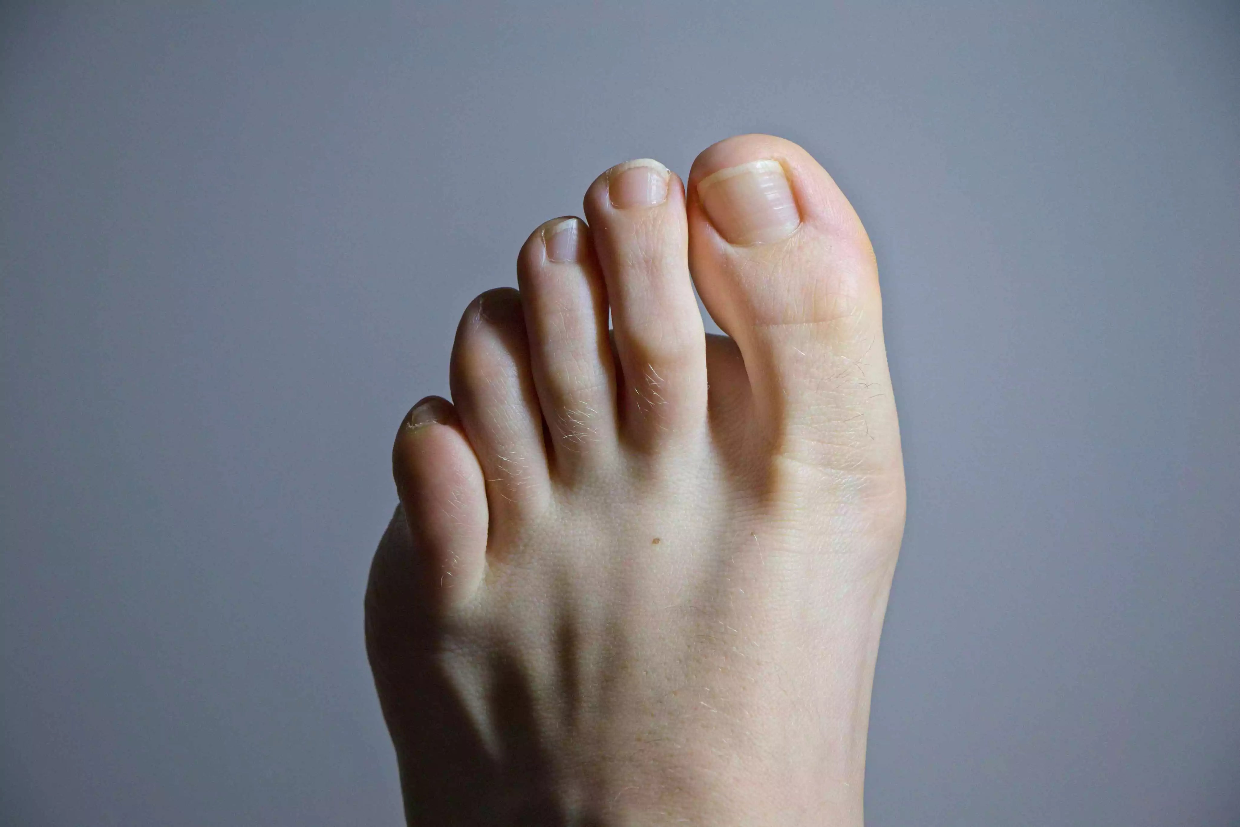 Hammer Toes Causes And Symptoms