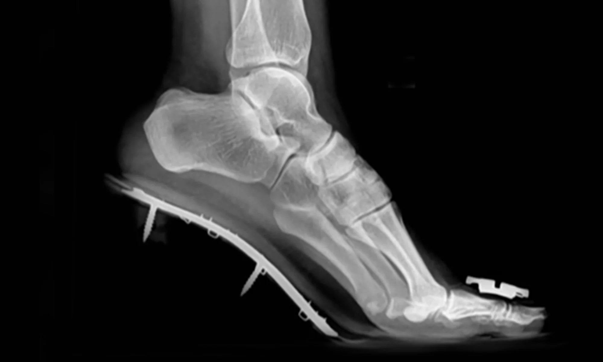 X-ray of Foot in Regular Heels